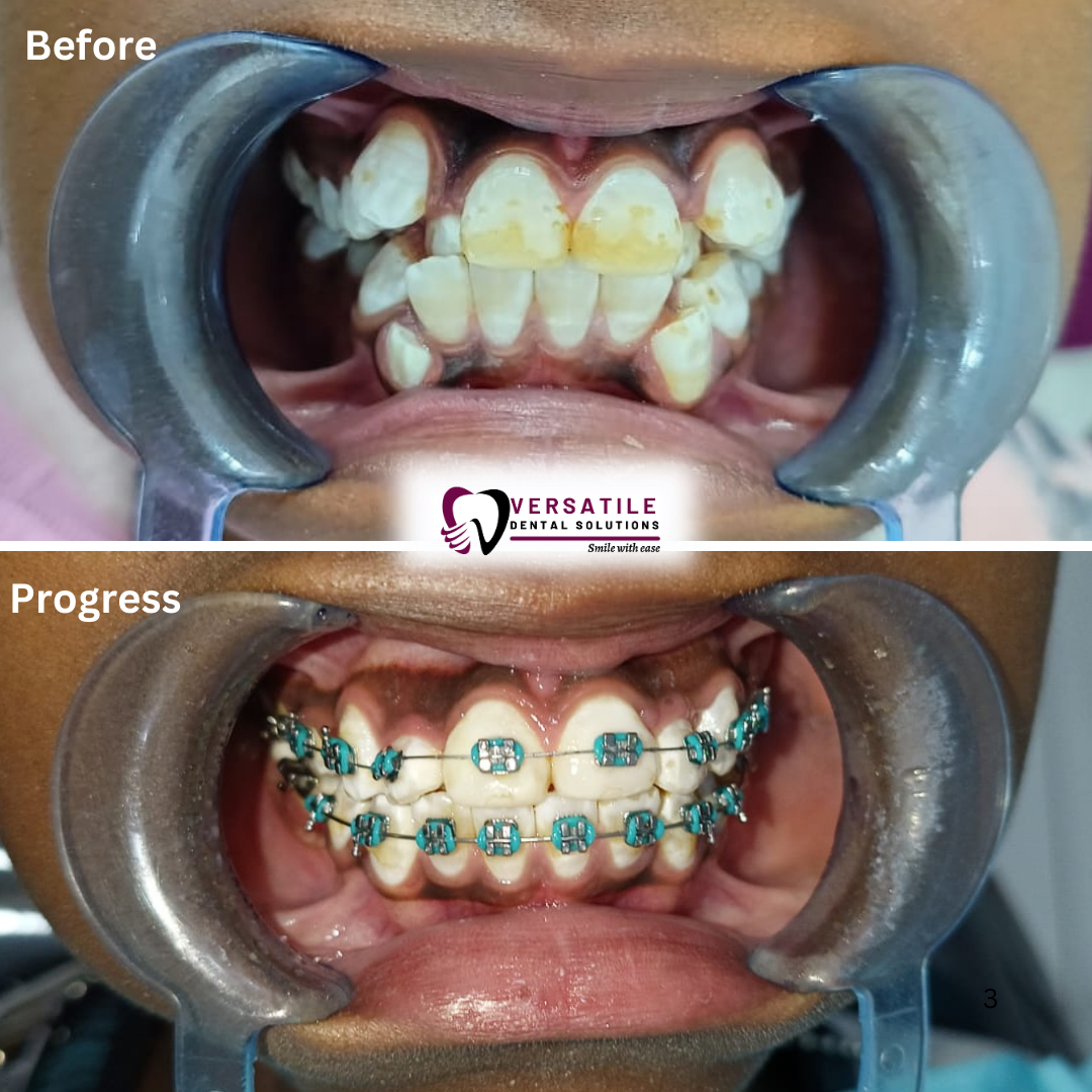 Teeth Alignment in Nairobi: The Ultimate Guide to Braces & Clear Aligners for Your Best Smile